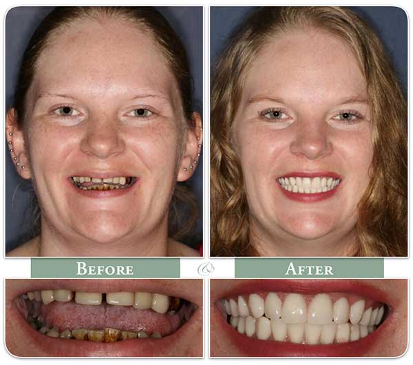 before and after of dramatic dental implant treatment