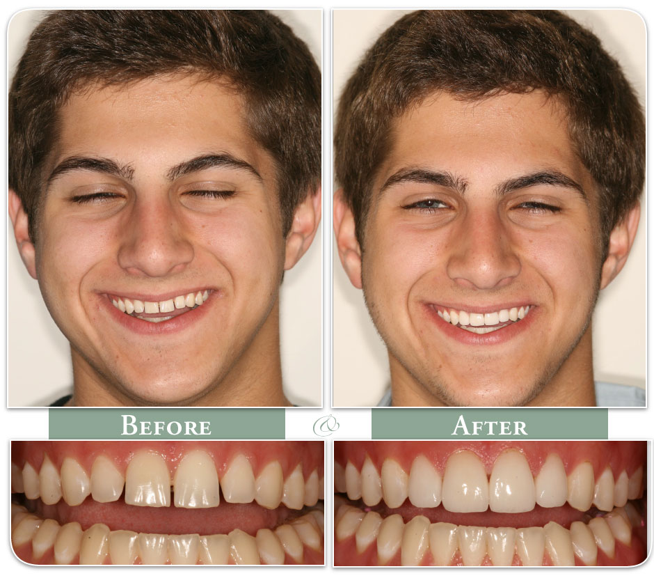 patient with veneers before and after