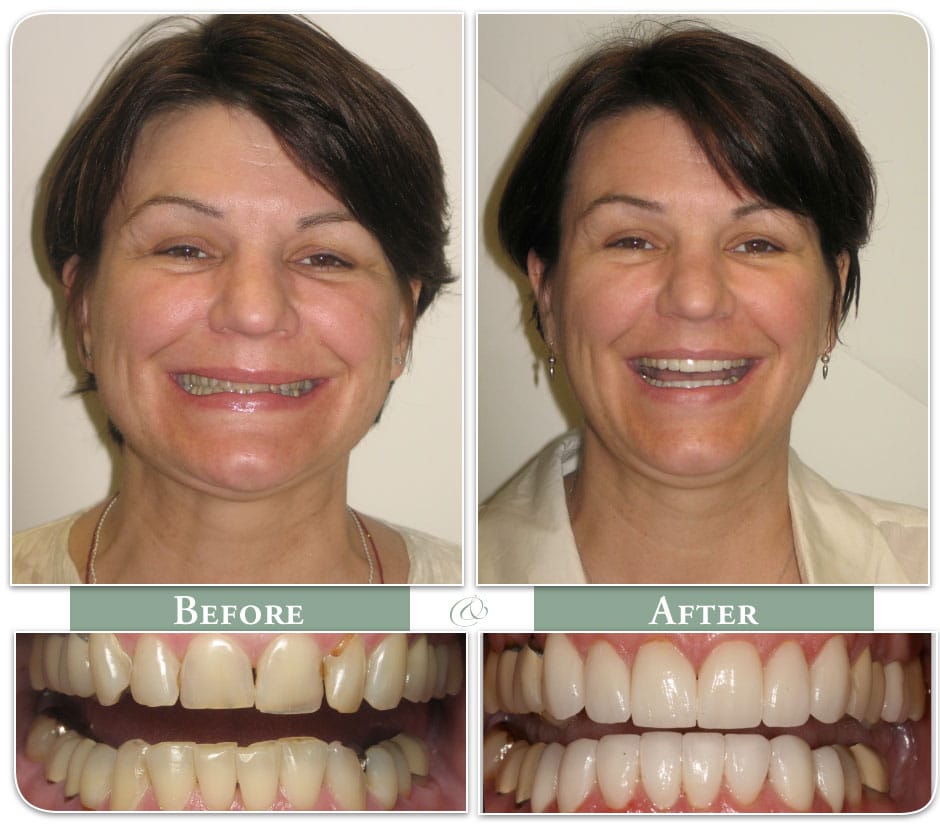 porcelain dental veneers on smiling patient