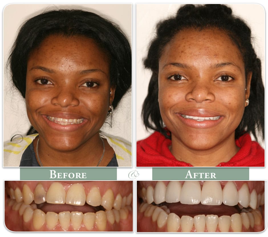 before and after of smiling patient with porcelain veneers