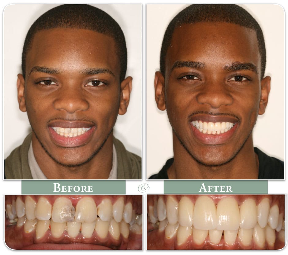 smiling patient with dental veneers