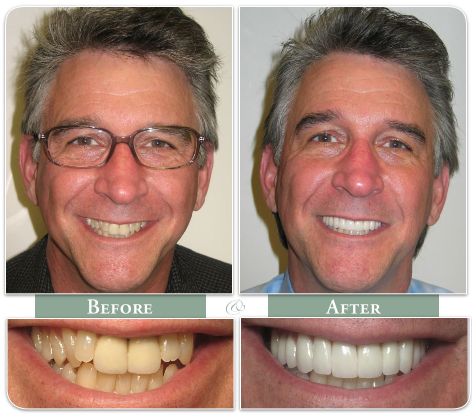 a spectacled man displays before and after his new veneers