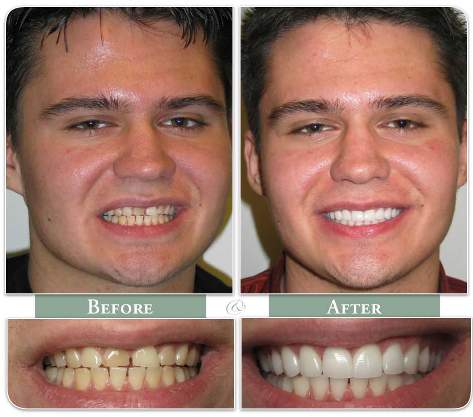 before and after image of young man with dental veneers case 16
