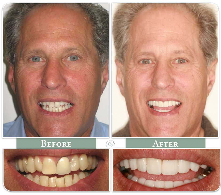 Mature patient in before and after images of dental veeners