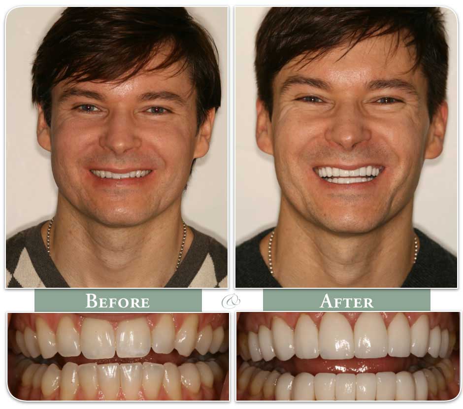 before and after image of a young man with dental veneers case 22