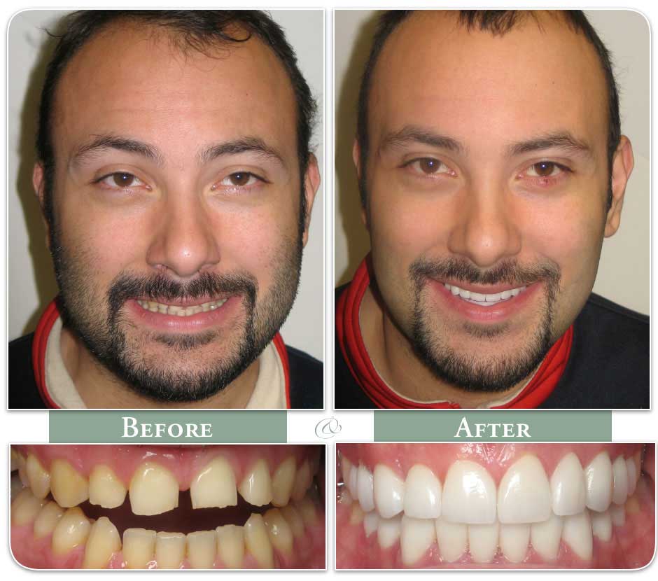 man with goatee in before and after images of dental veeners