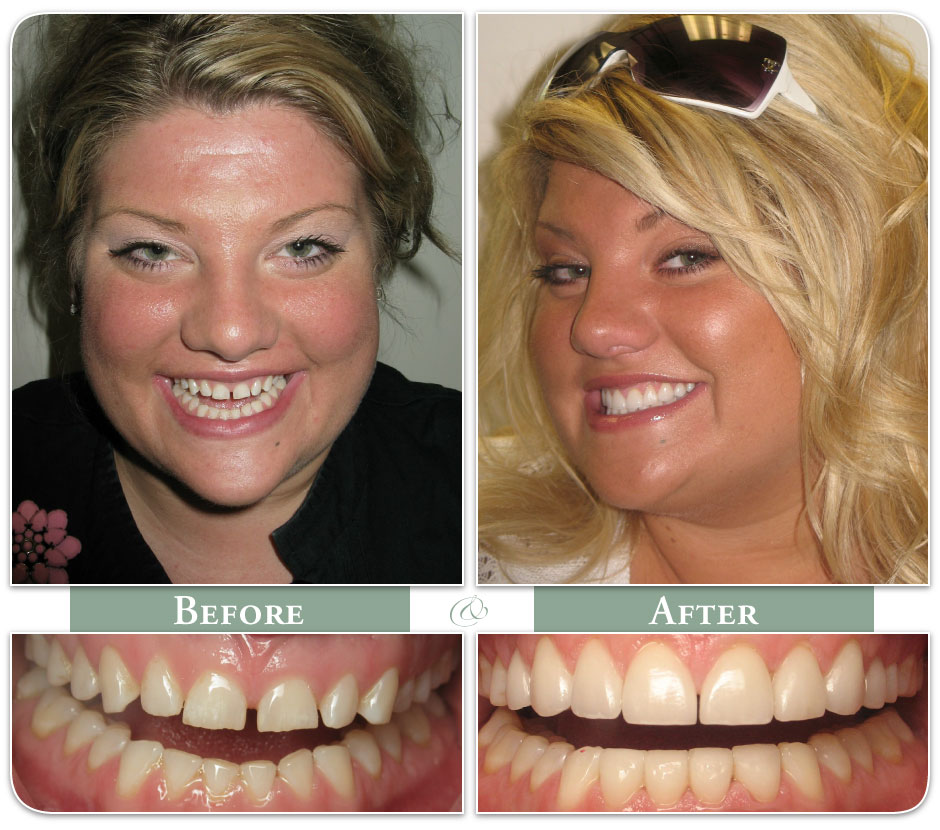 before and after veneer treatment