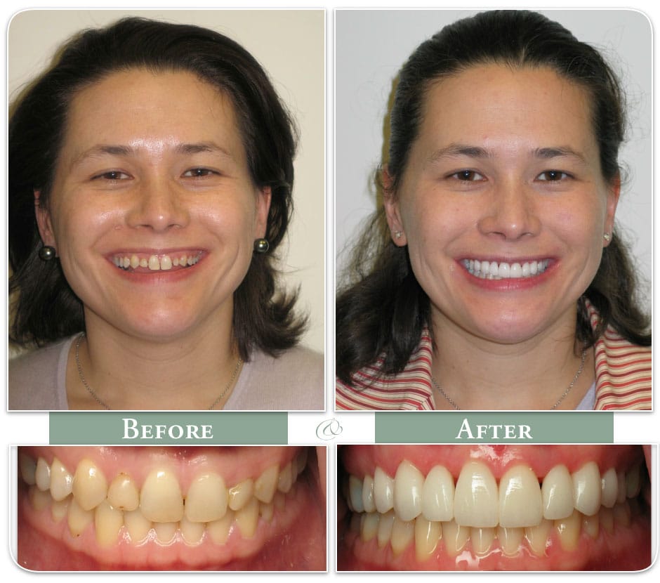 female patient in before and after dental veneers image