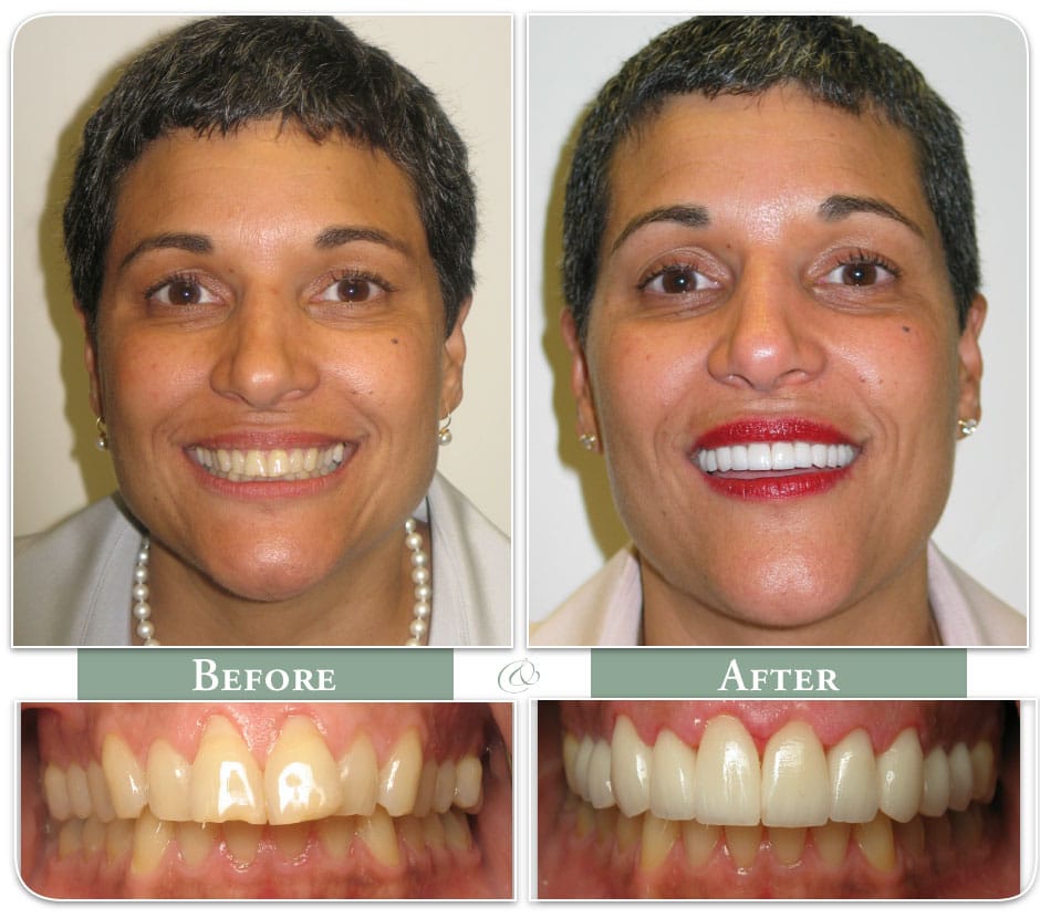 before and after image of woman with dental veneers case 29