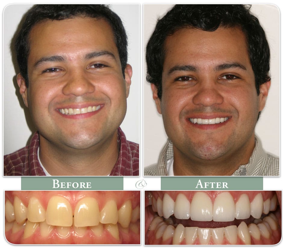 dental veneers before and after of patient