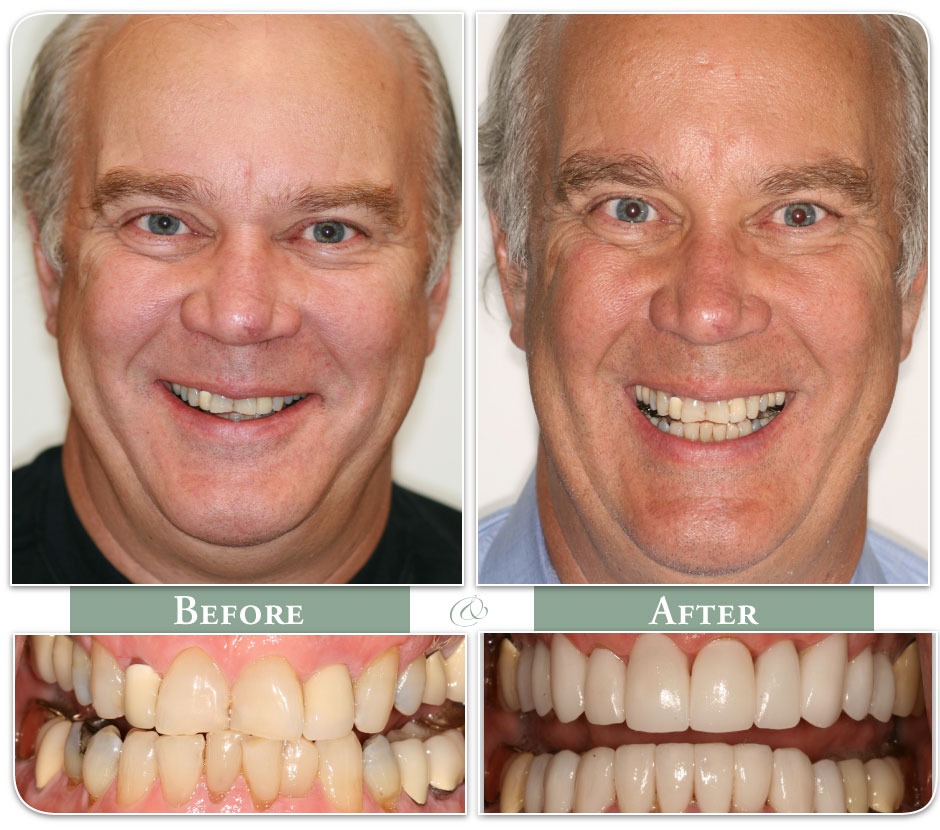 before and after image of a man with dental veneers case 35