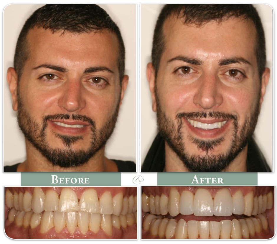 young man with goatee in before and after images of dental veeners