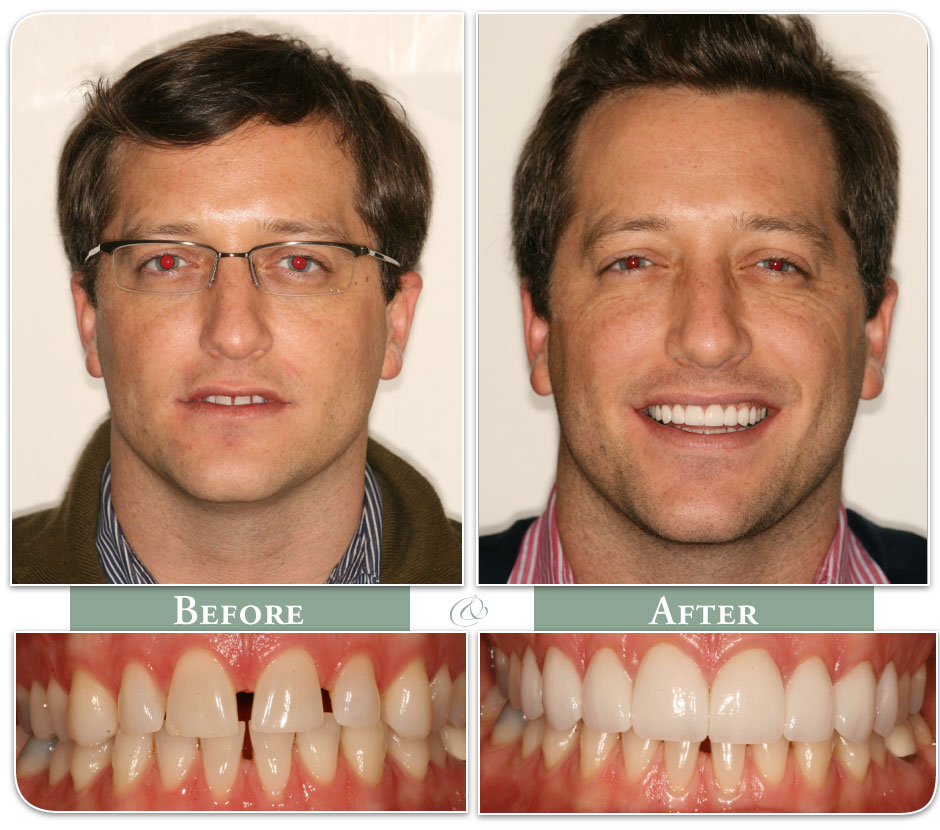 before and after of patient with dental veneers