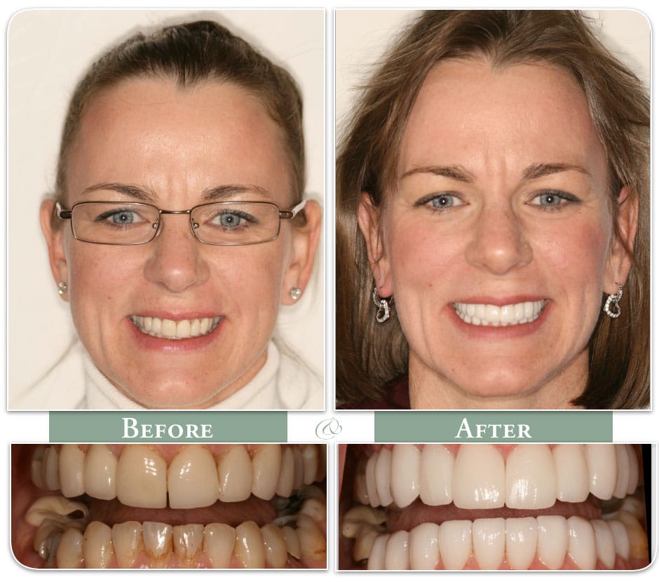 before and after of porcelain dental veneers