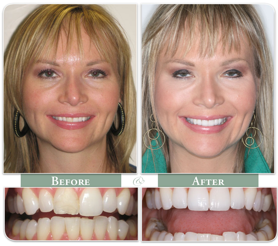 before and after image of dental veneer