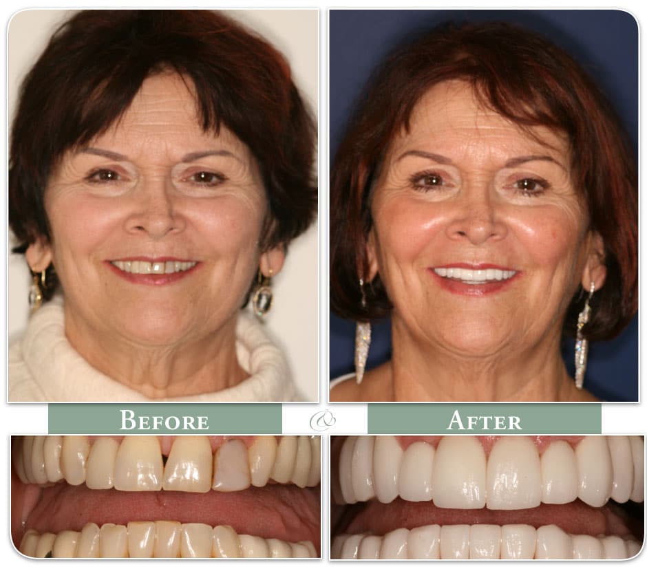 a woman shows her teeth before and after her new veneers