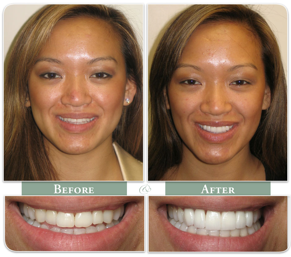 a woman shows off her teeth before and after veneers