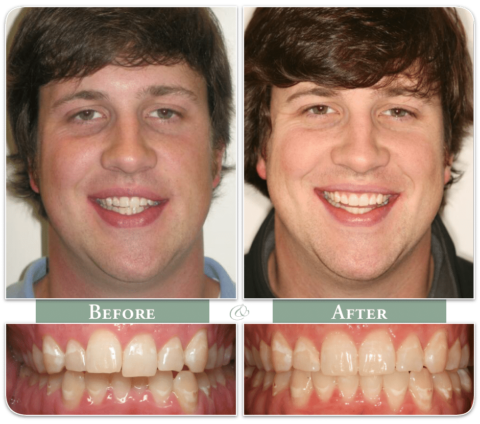 before and after images of a man's teeth