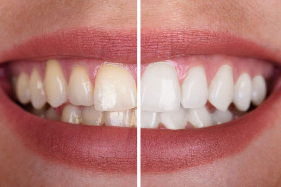 before and after teeth whitening