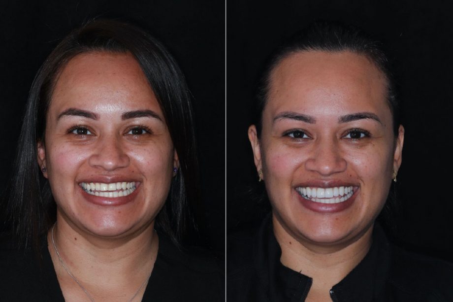 woman before and after teeth whitening