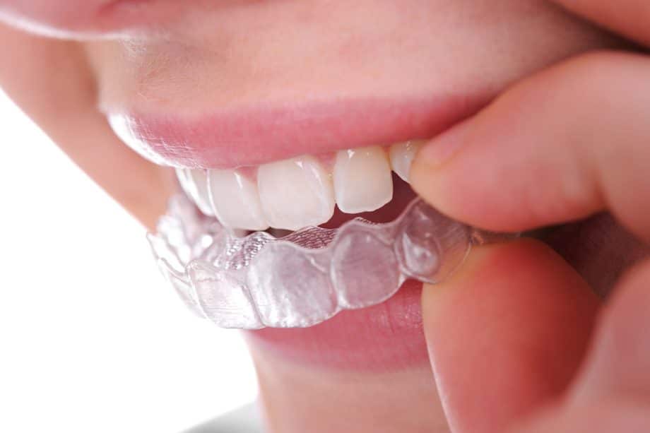 Can Invisalign Fix an Overbite?