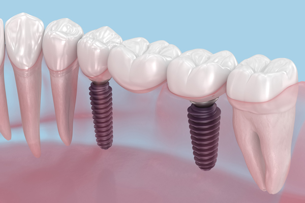 Complete Your Smile With An Implant Crown