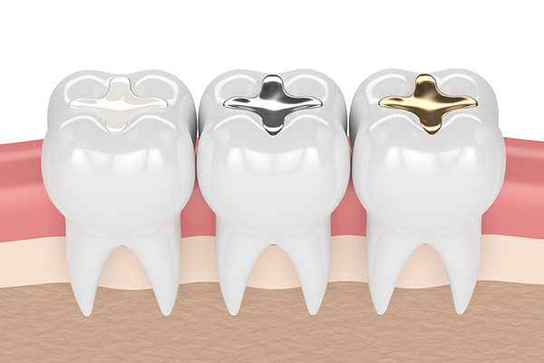 A General Dentist Answers Dental Filling Questions