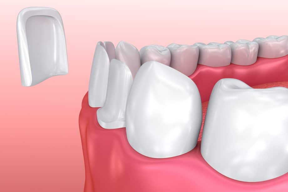 ow Composite Veneers are Different from Porcelain Veneers