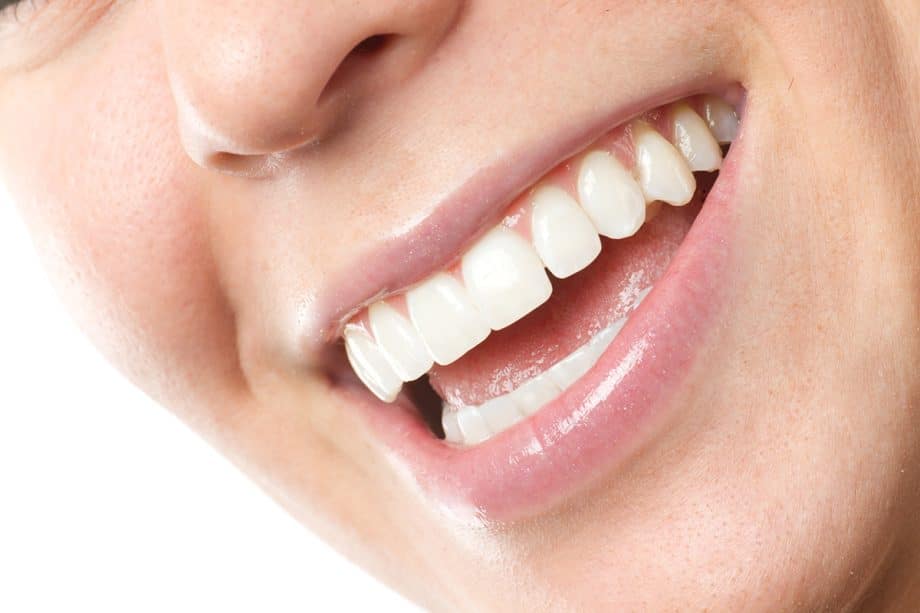 How Do Dental Veneers Work & Are They Permanent?