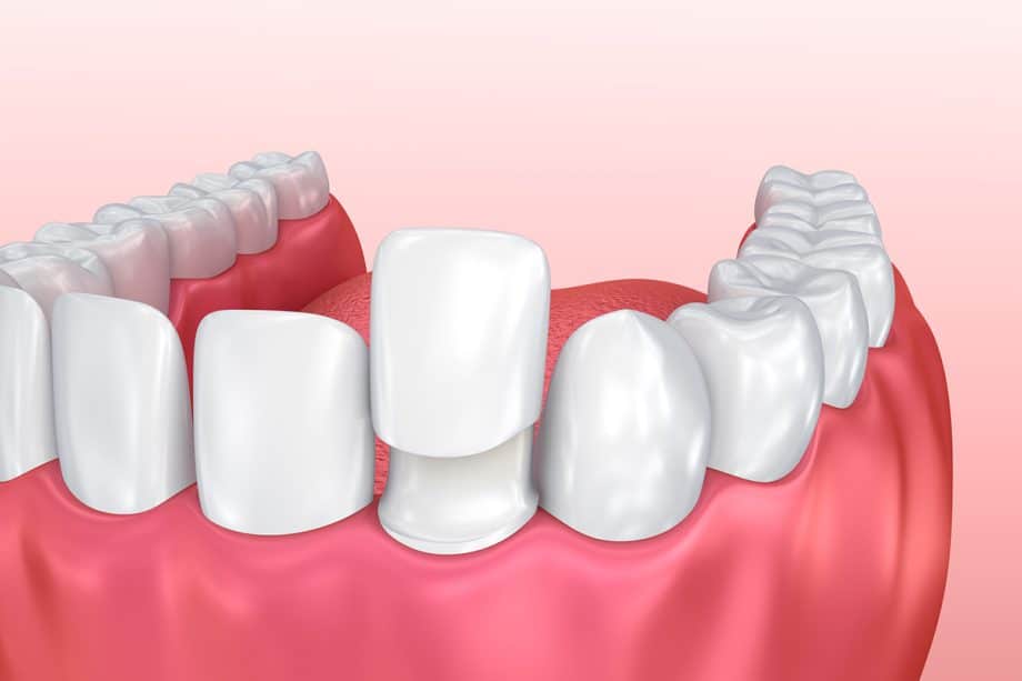 How Long Do Dental Veneers Last?