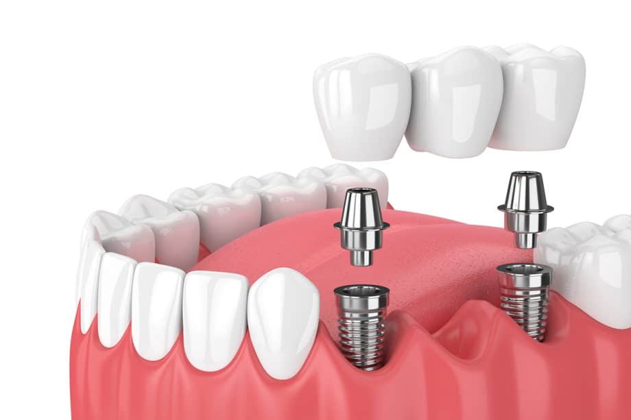 How Long Does It Take For a Dental Bridge To Settle?