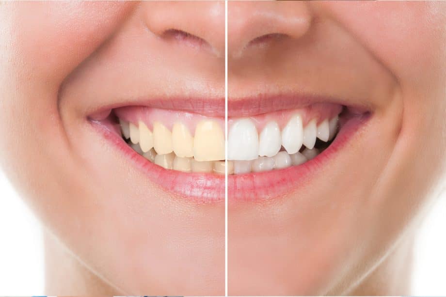 smile showing teeth before and after whitening
