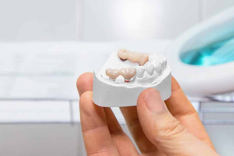How Should A Dental Bridge Fit?