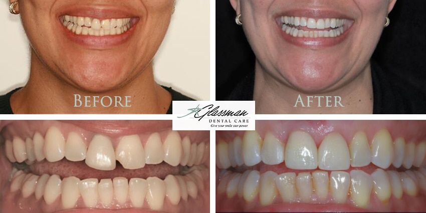 before and after dental implants photo