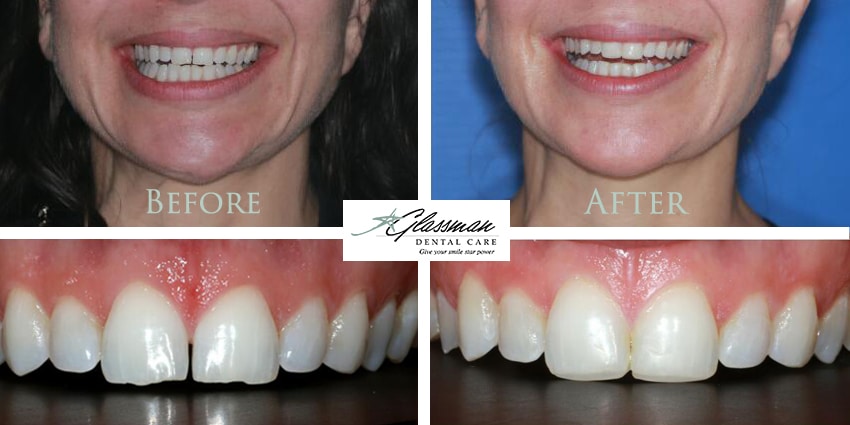 Invisalign before and after image