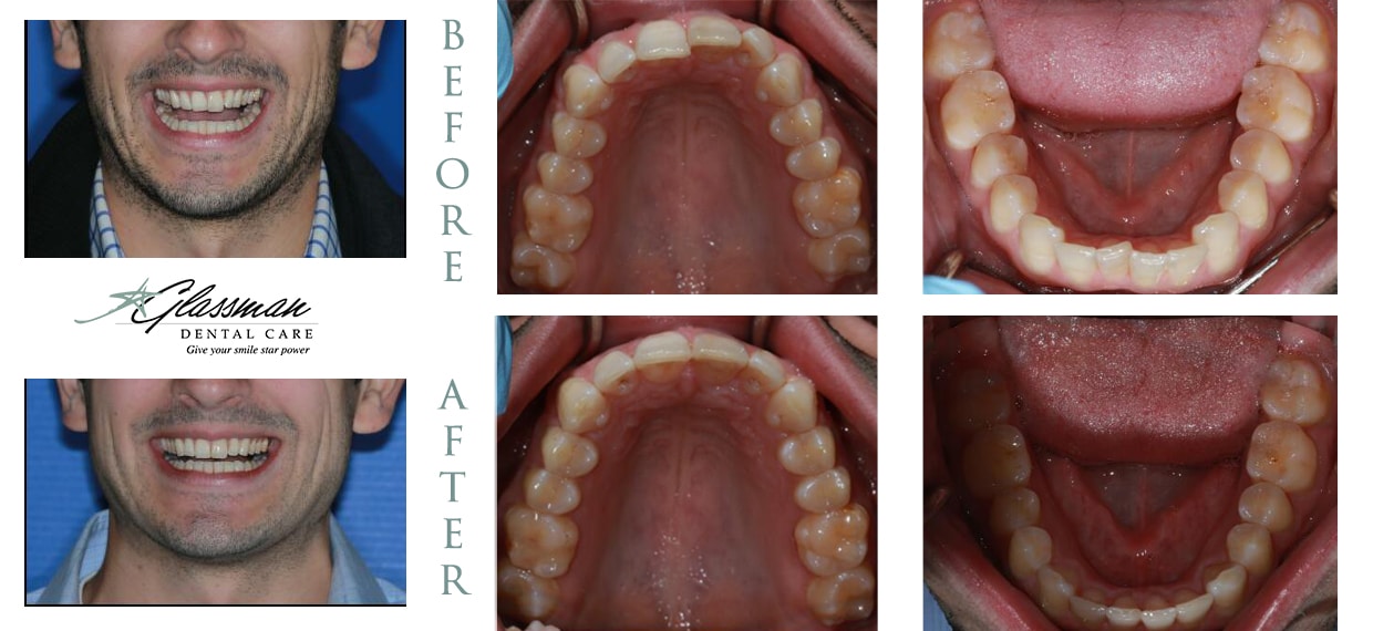 Invisalign before and after