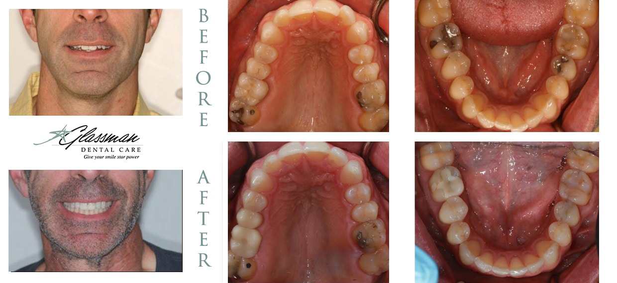 man displaying the before and after results of Invisalign