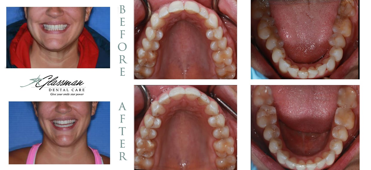 a woman displaying her teeth before and after Invisalign