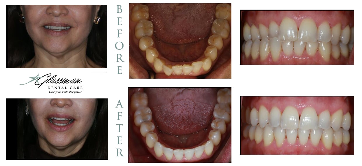 before and after photos of invisalign patient