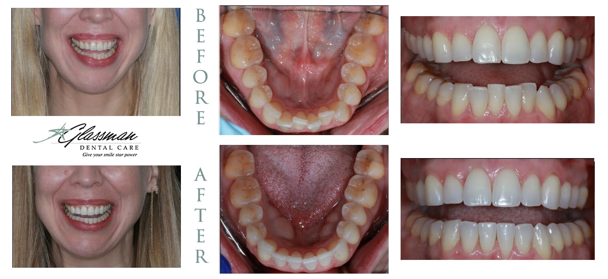 invisalign treatment on happy patient