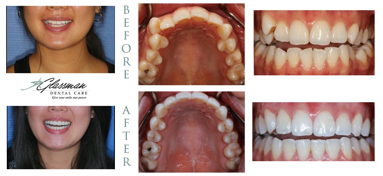 before and after invisalign for crowded teeth