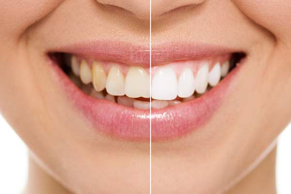 Before and After Image of Whitened Teeth