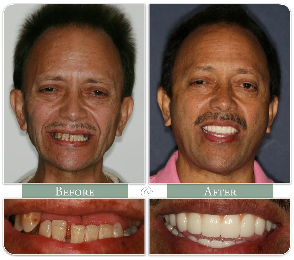 a man displays his teeth before and after dental implants