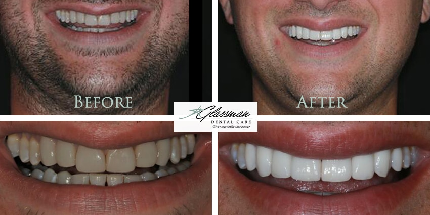 before and after of patient with dental new dental veneers