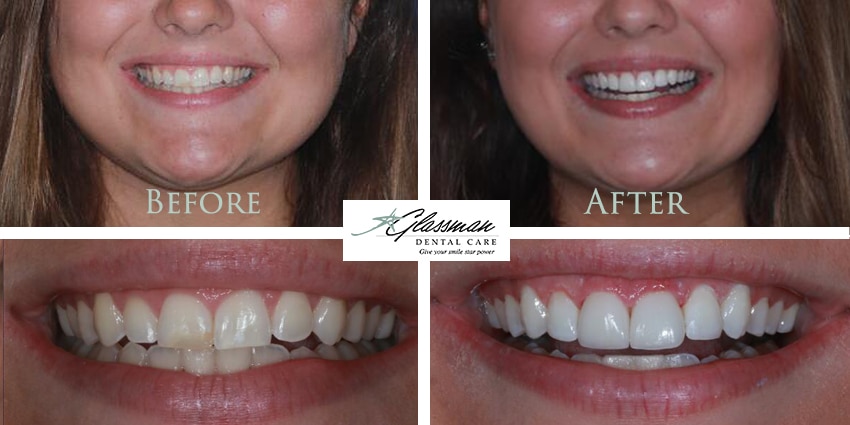 before and after dental veneers on patient