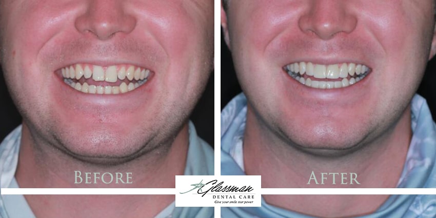 before and after photos of veneers