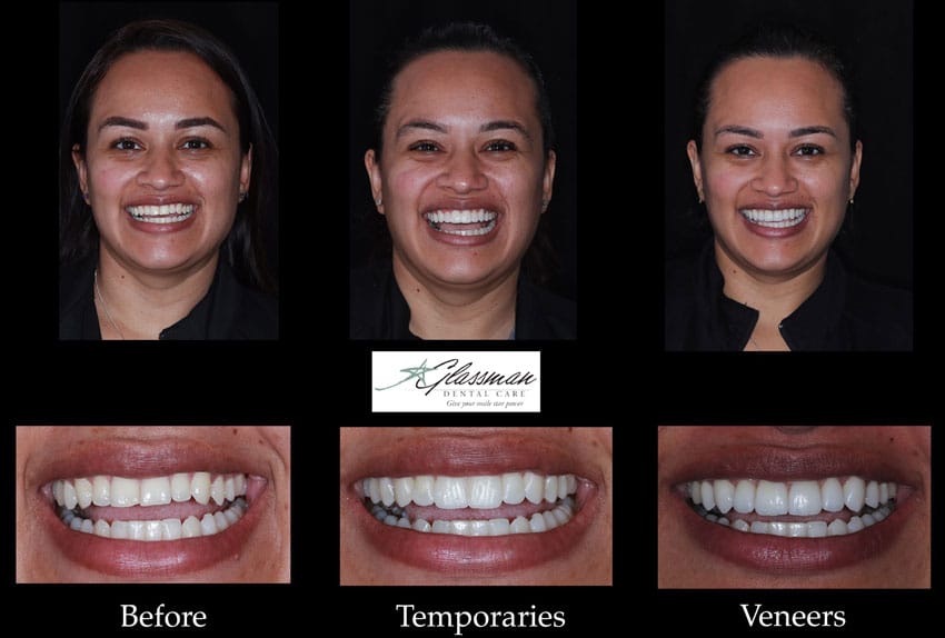 before and after images of temporary and permenant veneers