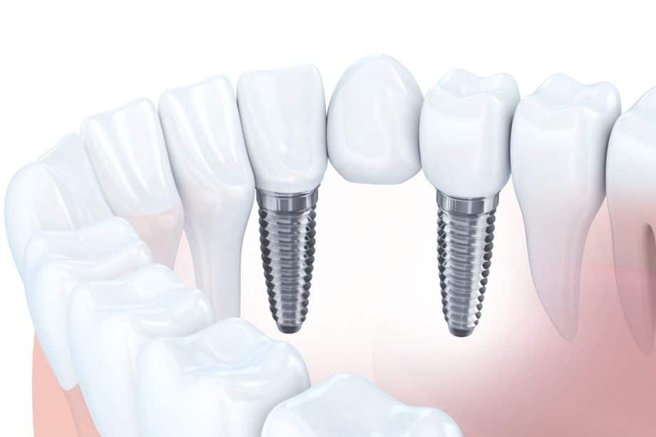 What Is A Dental Bridge? | Glassman Dental Care