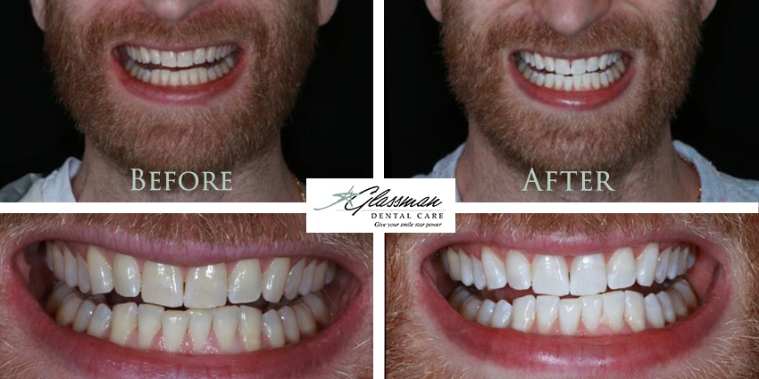 before and after patient teeth whitening