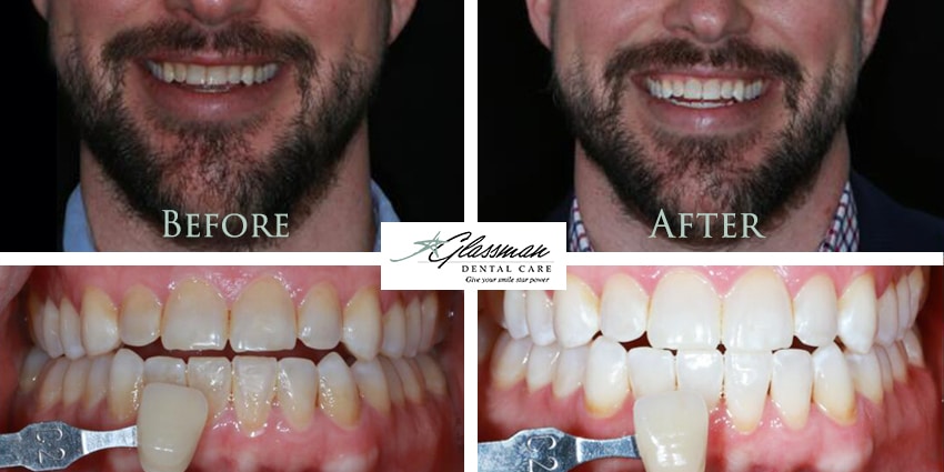 before and after professional teeth whitening